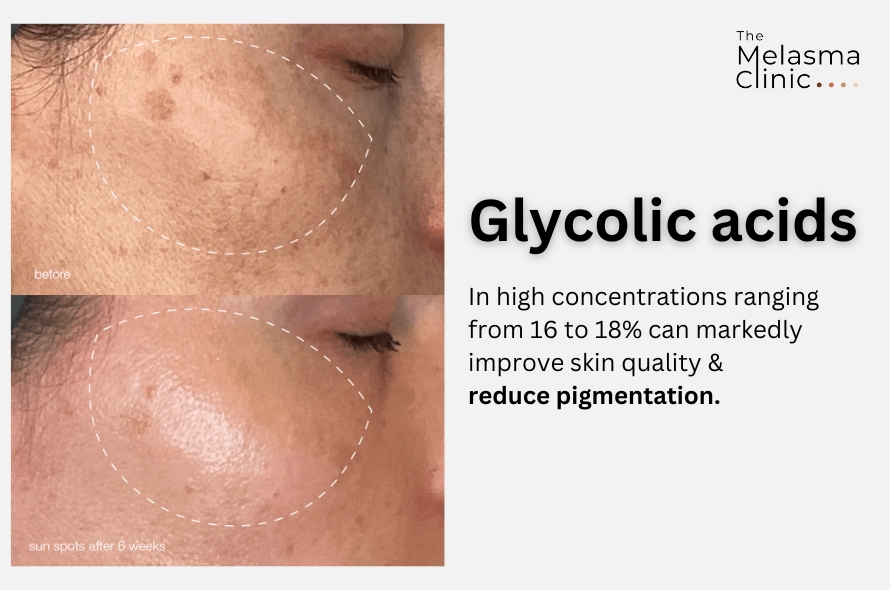 Glycolic Acid For Glowing Skin | Melasma Clinic Australia