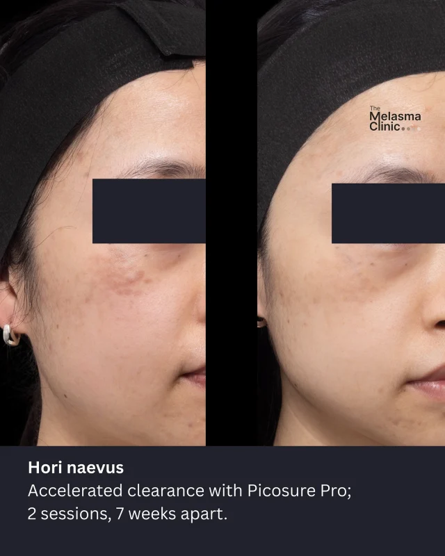 dhc glutathione Glutathione Skin Whitener: Dermatologist Guide 2026